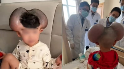 Băiețelul poreclit „Mickey Mouse” din cauza unei afecțiuni rare de piele a trecut printr-o transformare spectaculoasă FOTO